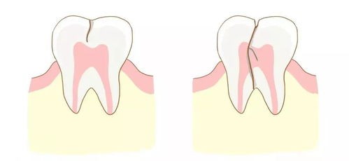 选择3M Lava拉瓦全瓷美白牙齿,看做过程需要什么麻醉?