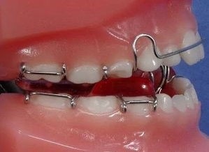 牙齿种植注意事项 做美国皓圣种植牙过程中该如何避免风险?