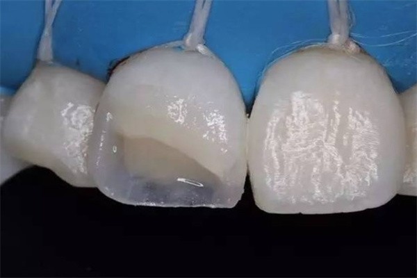 补牙后变色怎么办？树脂染色原因、抛光修补与换材料的可行性建议