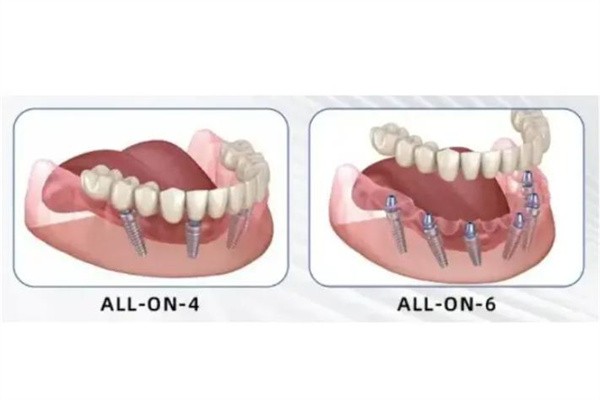All-on-4全口种植适合谁？费用、手术流程与复原期真实病例分享 