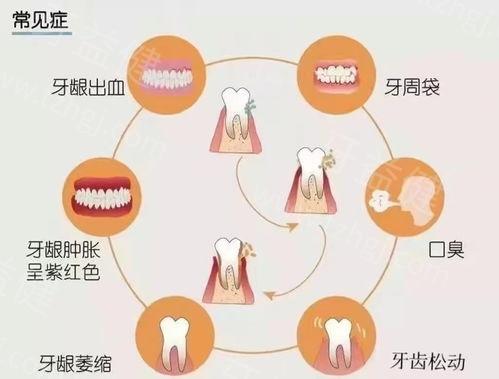 做以色列MIS种植牙前有什么忌口的？这几点你确实不能忽视！