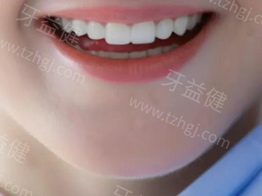 做美孜二氧化锆牙冠的过程是什么，过程中有什么风险吗？
