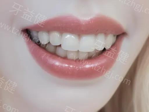 做无痛拔牙前，可以服用布洛芬吗？了解注意事项，轻松应对牙痛！