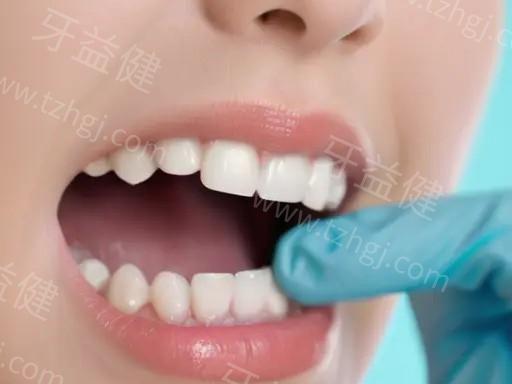 做烤瓷牙前，可以剧烈运动吗？了解这几点让你放心运动！