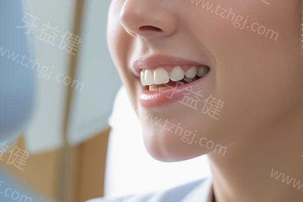 分享合肥牙科的医院贴面收费价格 树脂贴面/超薄瓷贴面//费用不贵